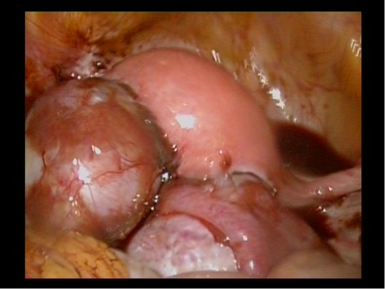 Endometriosis Ovarian Cysts Youssif Endometriosis Ovarian Cysts Youssif